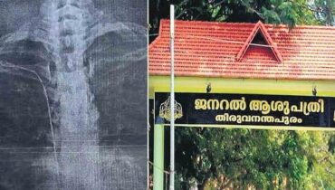യുവതിയുടെ നെഞ്ചിൽ ഗൈഡ് വയർ കുടുങ്ങിയ സംഭവം; ആശുപത്രിയിലെ ചികിത്സാ പിഴവിൽ ഡോക്ടർക്കെതിരെ കേസ് എടുത്തു