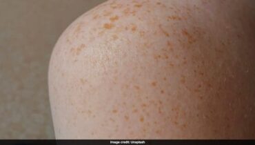 അതീവ ഗുരുതരം: അഞ്ചാം പനി ബാധിച്ച യാത്രക്കാരൻ ന്യൂവാർക്ക് വിമാനത്താവളത്തിൽ; ന്യൂജേഴ്‌സിയിൽ ജാഗ്രതാ നിർദ്ദേശം