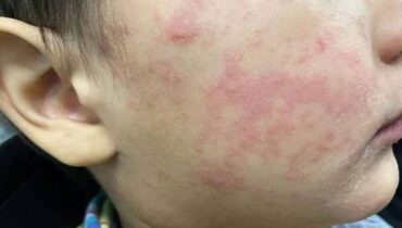 അമേരിക്കയിലെ ദക്ഷിണ കാരോലൈനയിൽ മീസിൽസ് പടരുന്നു;  നാല് ദിവസത്തിനിടെ റിപ്പോർട്ട് ചെയ്തത് 88 കേസുകൾ